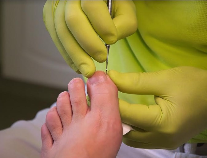 DIF Zapopan exhorta a proteger los pies en la temporada de calor